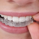 invisalign